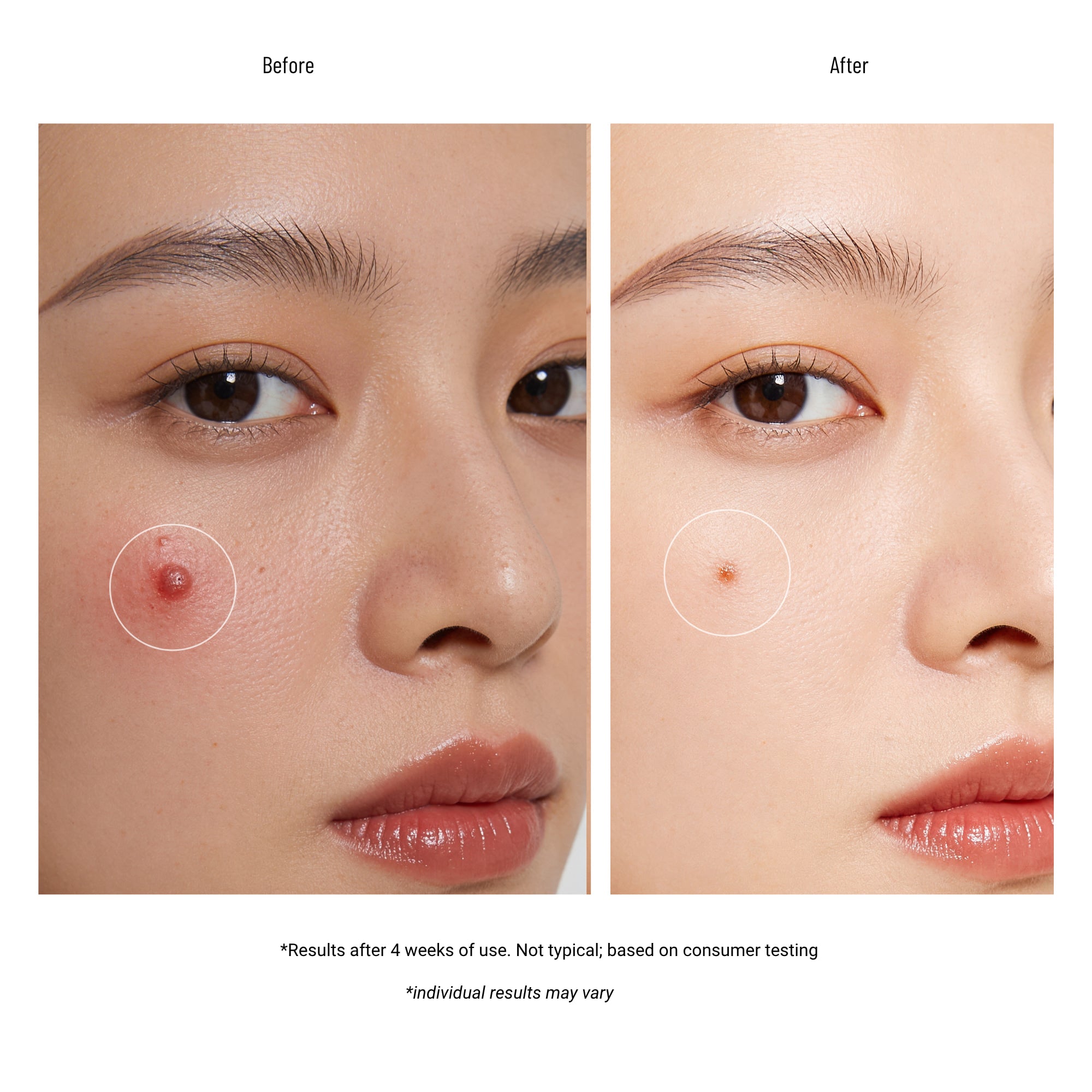 Acne Free Terminator 10 Acne Spot Treatment