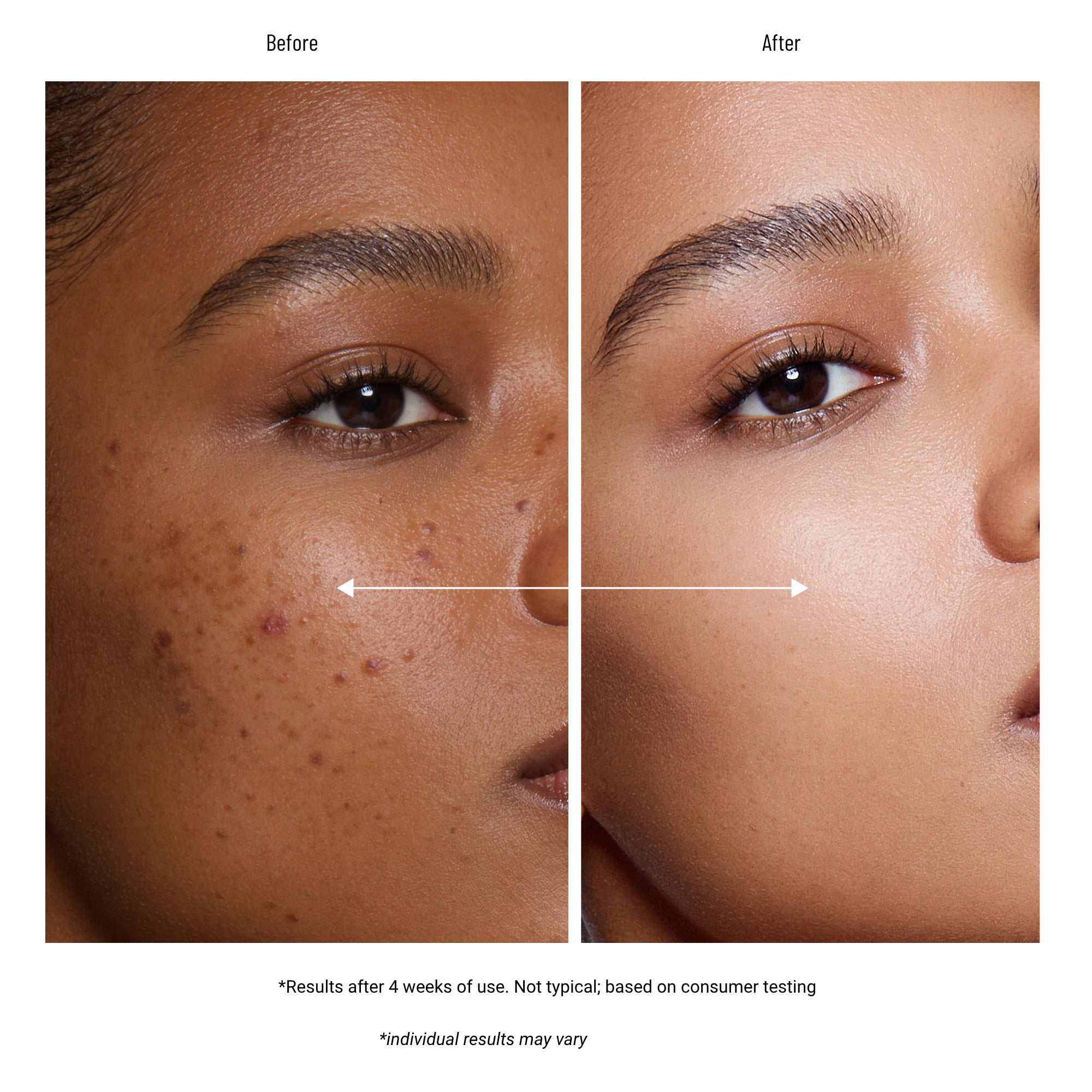 Glytone Acne Clearing Cleanser for Acne & Blemishes