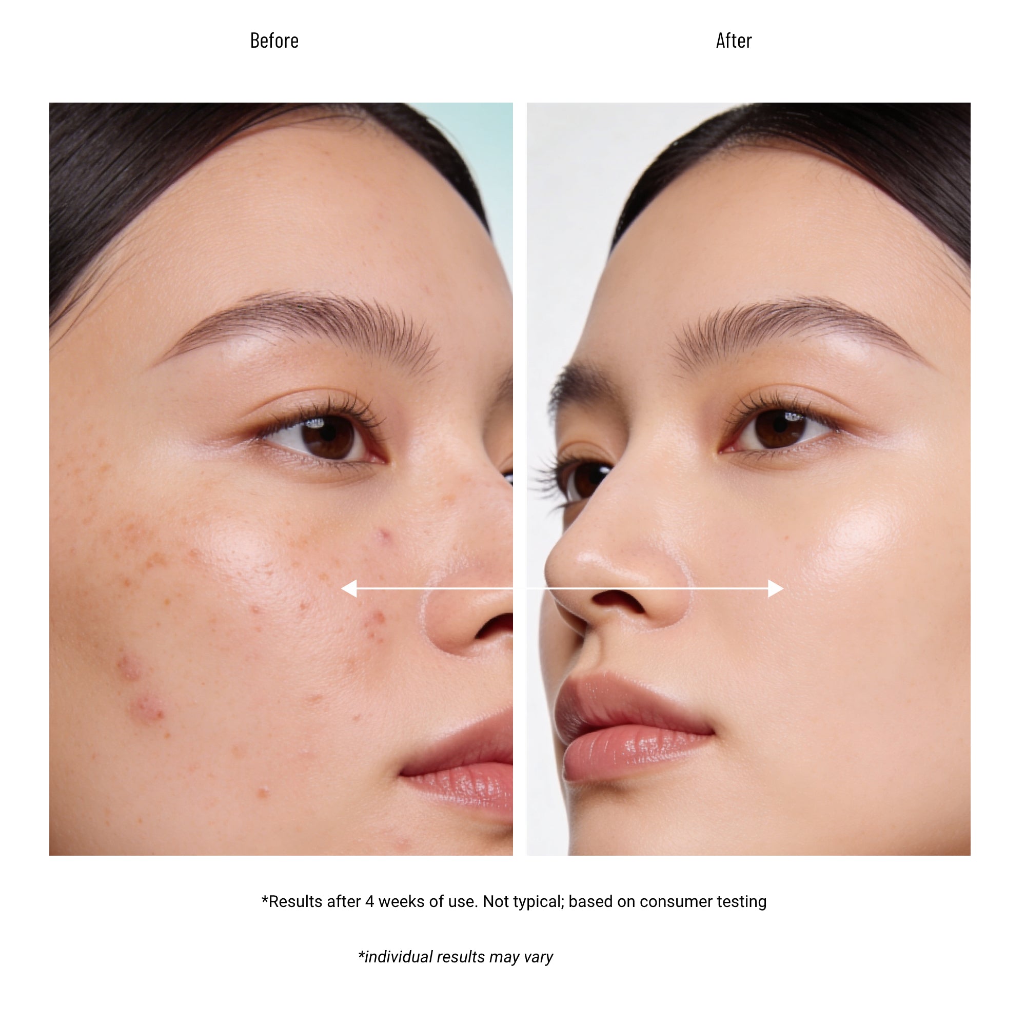 Glytone Acne Clearing Cleanser for Acne & Blemishes
