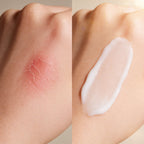 Before and after comparison of a skin blemish with cream application on a beige background